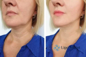 Double chin before and after Hi-Fu treatment 4 Book your double chin treatment Anstey today! We are here to help!