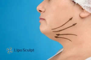 Double chin before and after Hi-Fu treatment 3 Boost your confidence with a Double chin treatment Anstey