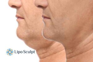 Double chin before and after Hi-Fu treatment 2 Double chin treatment Anstey from Lipo Sculpt - feel more confident today!