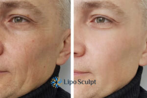 How to Fight Aging Symptoms 3 Fight Aging Symptoms Anstey With HIFU and Morpheus8 Today!