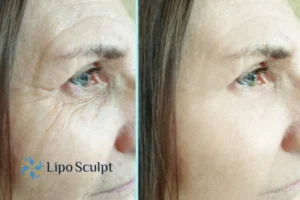 How to Fight Aging Symptoms 2 Do you want to Fight Aging Symptoms Anstey? Contact Lipo Sculpt today!