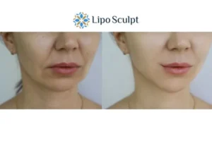 Explaining Total Skin Tightening Treatment And What It Can Do For You 2 Do you want to boost your self confidence? Give Morpheus8 Anstey a try today!