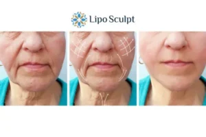 Explaining Total Skin Tightening Treatment And What It Can Do For You 3 Boost your confidence with Morpheus8 Anstey call our team today!