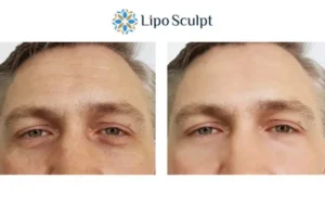 Explaining Total Skin Tightening Treatment And What It Can Do For You 6 Morpheus8 Anstey book in today to find out more!