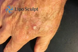 Best Actinic Keratoses Removal 2 Improve your wellbeing and health with Actinic Keratoses Anstey removal.treatment
