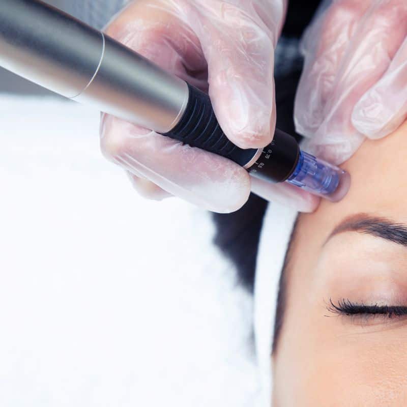Morpheus8 treatment Anstey from Lipo Sculpt - Book in today!