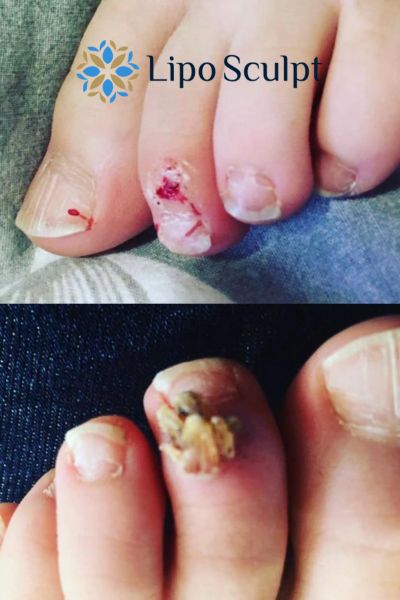 Wart removal customer results from Lipo Sculpt Anstey