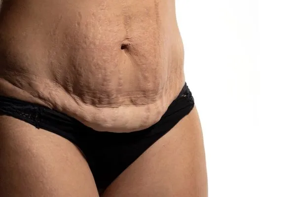 Lost the Weight but Not the Loose Skin? 1 image of womans stomach after weight loss showing loose skin Anstey